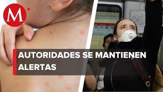 Brote de coronavirus y sarampión en CdMx