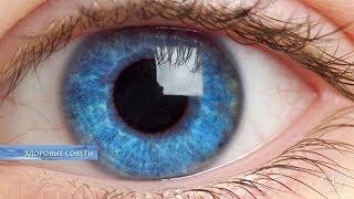 3 симптома синдрома «сухого глаза», о которых вы не знали! Лечение. Советы офтальмолога