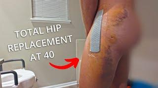 An Ultrarunners Total Hip Replacement Surgery / Tips & 1st Week Post Op Journey Ep.1