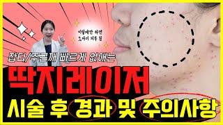 루비레이저/엑셀V/아꼴레이드 딱지 레이저 받았다면 필수 영상!! 잡티 주근깨 박멸하기