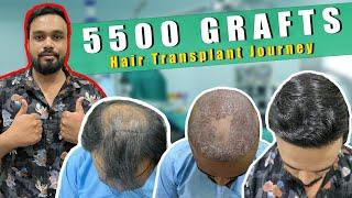 Best Hair Transplant in Bhubaneswar | Best Hair Transplant Result & Cost in Bhubaneswar