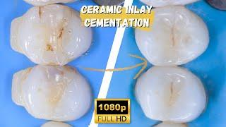 INLAY DELIVERY WITH WARM COMPOSITE | A BIOMIMETIC APPROACH