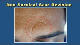 Non Surgical Scar Revision with Cannula & Laser. For Enquiry Contact: 970002 0802