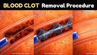 Blood Clot Removal Procedure | Medical Animation