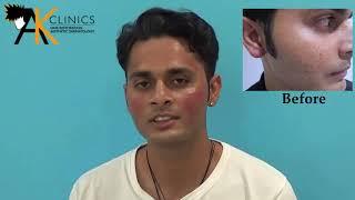 AK Clinics Acne Scar Treatment Result