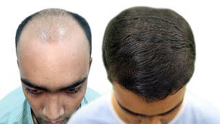 Best Hair Transplant in Kolkata | Best Hair Transplant In Bangladesh |