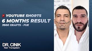 Dr.Cinik Hair Transplant Clinic - FUE - Before After 3900 Grafts - Beard Growth Results in 6 Months