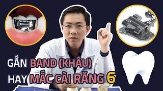 Vì Sao Phải Gắn Band (Khâu Chỉnh Nha) Mà Không Phải Mắc Cài Răng Số 6 Và Ngược Lại?