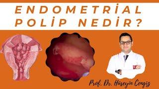 ENDOMETRİAL POLİP NEDİR?  (Rahim içi polip ve tedavisi)