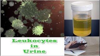 Leukocytes in Urine - No Nitrates