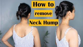 5 Exercises for Neck Hump | How to Fix Neck Hump | Fix your Neck Hump