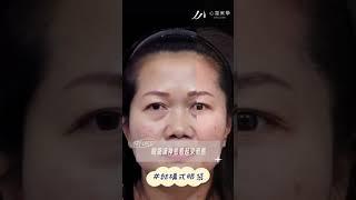 『案例分享』 #結構式眼袋，讓年齡不再有袋溝 ｜台北中山區醫美整形權威-心湛美學診所    Feat.李存昌院長