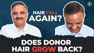 Do Hair Transplants Ever Look Natural?