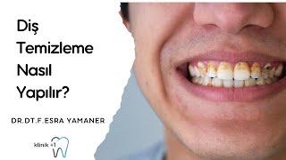 Diş Taşı Temizleme (Detertraj) Neden Yapılır? Ne Sıklıkta Yapılmalıdır?Klinik+1 Suadiye
