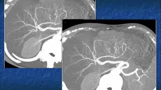 CT and CTA Evaluation of Hepatoma Part 2