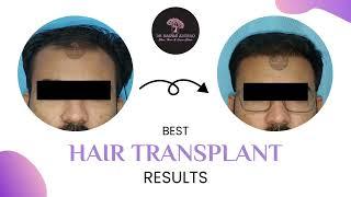Get Hair Transplant Treatment | Grade V-VI hair transplantation | Dr. Rashmi Aderao Clinic