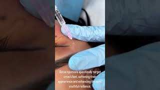 Say Goodbye to Crow's Feet with Botox Injections at EDEN AESTHETICS Dubai | Youthful Eyes Radiance