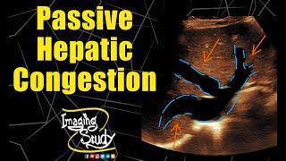 Passive Hepatic Congestion || Ultrasound || Doppler || Case 188