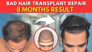 Hair Transplant in Lucknow | Best Results & Cost of Hair Transplant in Lucknow