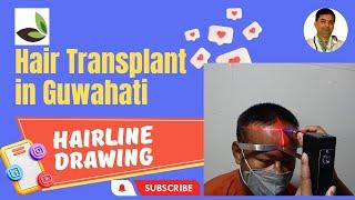 Hair Transplant Guwahati Assam || Hairline Drawing in Hair Transplant at Arogyam Clinic