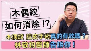 木偶紋拉皮手術真的有效嗎? 木偶紋如何消除? 林敬鈞醫師告訴你!!｜林敬鈞抽脂拉皮眼袋美學｜巨星整形外科