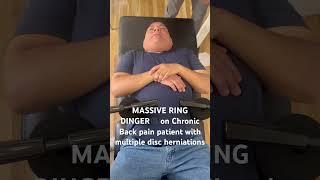 3 solid years of back pain responds beautifully to MASSIVE Ring Dinger®️manual spinal decompression