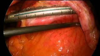 Sleeve gastrectomy- full technique video.mov