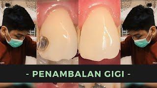 Tambalan Gigi Komposit | Dentist | Dokter Gigi Tri Putra