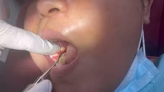 Extraction of erupted wisdom tooth