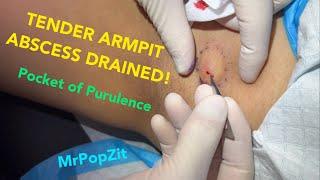 Tender armpit pocket of Purulence drained! Bits of broken down cyst found. Follow up at end of video