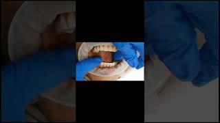 Durable GCAM -graphene- full arch implant bridge -amazing smile make over in just 4 days! #shorts