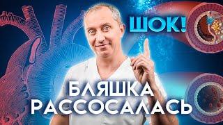 Шок! Бляшка рассосалась! Атеросклероз