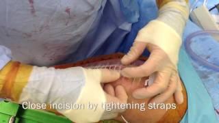 Zip Surgical Skin Closure, manufactured and submitted by ZipLine Medical Inc  USA2