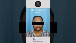 Hair Transplant | Before and After Comparison | Dr. Rashmi Aderao Skin, Hair & Laser Clinic