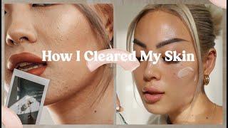 How I Cleared My Skin | acne & acne scars, skincare tips, lifestyle changes, self care tips