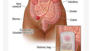 UROSTOMY || STOMA || CONTINENT URINARY DIVERSION || OSTOMY by Dr Raj Mishra#neet #video #best #bio