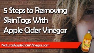 Using Apple Cider Vinegar to Remove Skin Tags in 5 Simple Steps