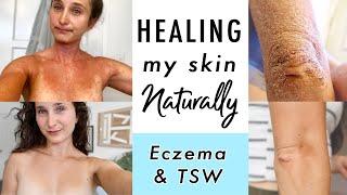 How I CURED Eczema & Topical Steroid Withdrawal NATURALLY | My Skin Healing Journey