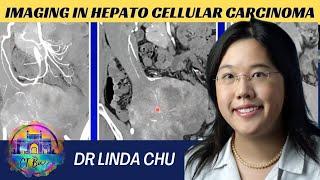 DR LINDA CHU | HEPATOCELLULAR CARCINOMA #ctbuzz