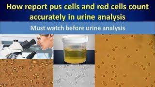 How report pus cells, red cells in urine deposit.#Urineanalysis#Urine#UFR#Urinefullreport.