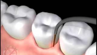 Animation of Laser Periodontal Therapy