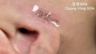 日常清耳朵粉刺短片 Daily ear blackhead cleaning clip