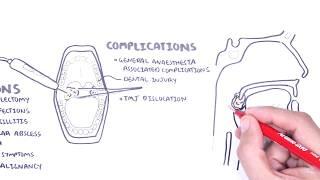 Acute Tonsillitis - causes (viral, bacterial), pathophysiology, treatment, tonsillectomy