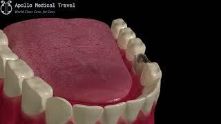 Animated Dental Extraction | Apollo Medical Travel