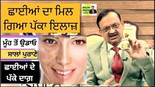 ਛਾਈਆਂ ਦਾ ਮਿਲ ਗਿਆ ਪੱਕਾ ਇਲਾਜ਼ | Face Blemishes Home Remedy | Health Advice With Harjot Kaur