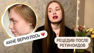 Рецедив акне после ретиноидов / Акне вернулось / Наружное лечение акне / Эффезел