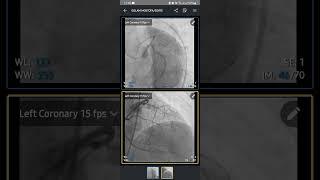 Mobile: How to Open Angiogram/Angiography Report DICOM viewer with phone