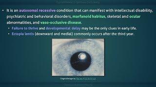 Homocystinuria: Cystathionine β-Synthase (CBS) Deficiency