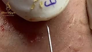 Blackheads extraction  (279_ep 1) | Loan Nguyen