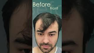 {2024) Hair Transplant Results Frontal + Crown #shorts